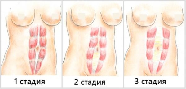 Диастаз после родов: что это такое и как лечить