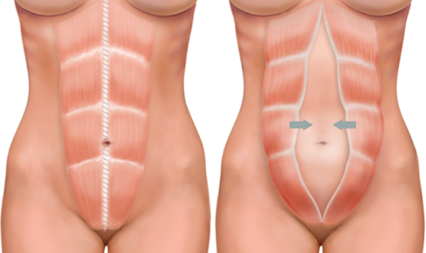 Диастаз после родов: что это такое и как лечить